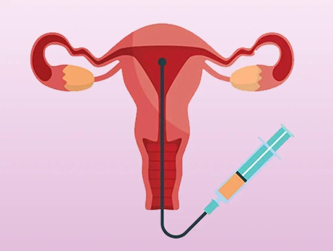 Intrauterine Insemination (IUI)