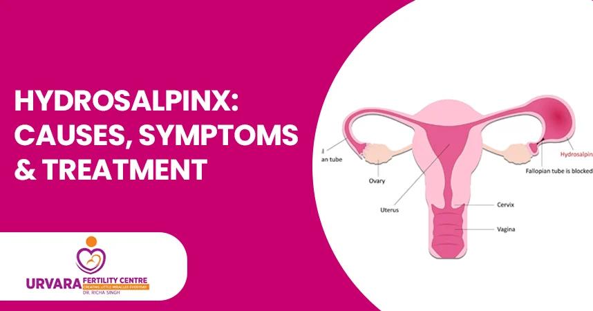 Hydrosalpinx: Causes, Symptoms & Treatment