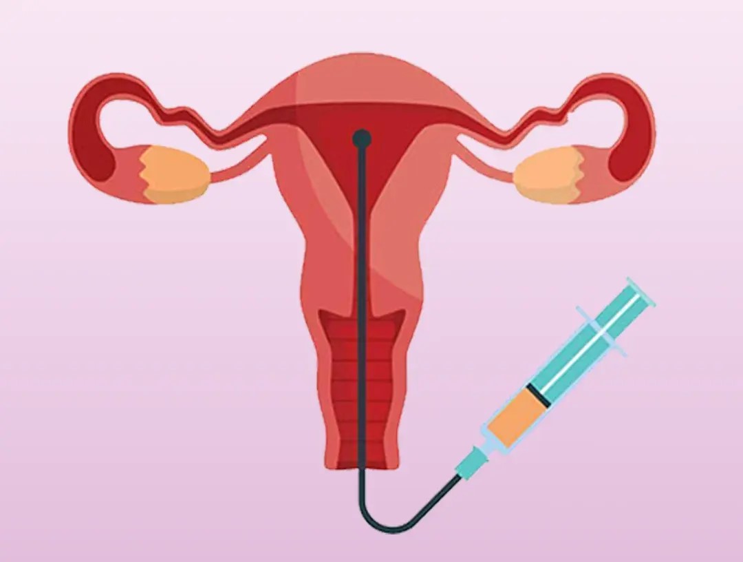 Intrauterine insemination (IUI)